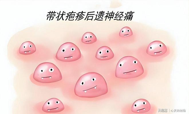人不会无缘无故患带状疱疹！调查发现：得带状疱疹离不开这4点